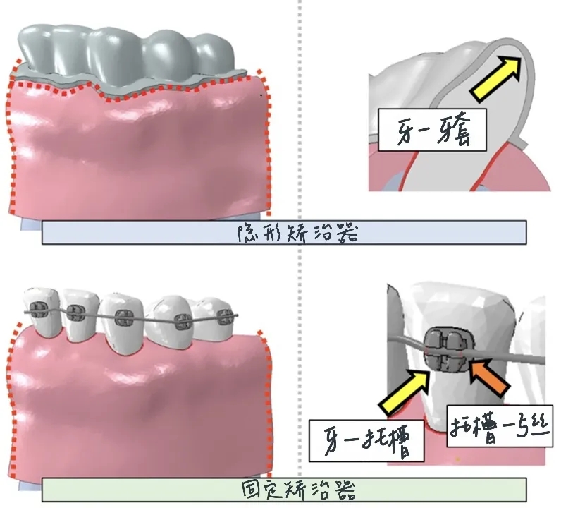 固定矯治器.webp.jpg